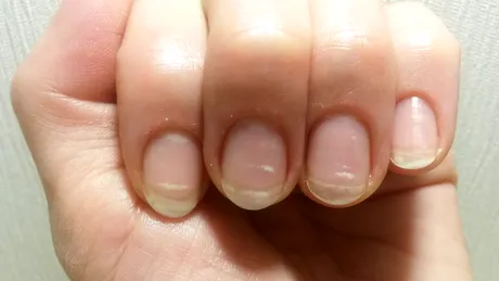 Ce sunt petele albe de pe unghii și din ce cauze apar?