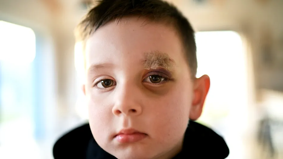 A crezut că fiul ei de 1 an are doar un ochi învinețit de la o mică accidentare. În realitate, micuțul suferea de o boală gravă