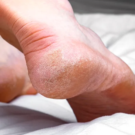 Trucul uimitor pentru călcâie fine. Ai nevoie de un singur ingredient, iar până mâine pielea ta va fi mătăsoasă