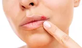 Simți că îți apare herpes? Ce să faci imediat ca să nu erupă