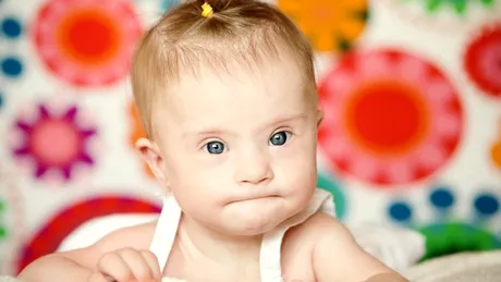 Sindromul Down: simptome, cauze, diagnostic, tratament