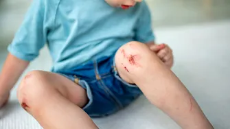 O simplă julitură se poate transforma într-o infecție periculoasă la copii. La ce trebuie să fie atenți părinții