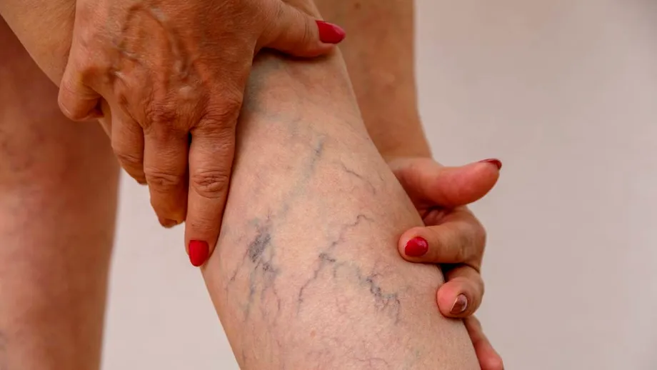 Leacuri pentru venele sparte de sub piele. Nu „șterg” instant vasele sparte, dar scapi de roșeață și inflamație