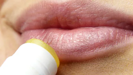 Herpesul iarna: prevenție și tratament