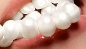 Faţetele dentare: prefabricate vs la comandă