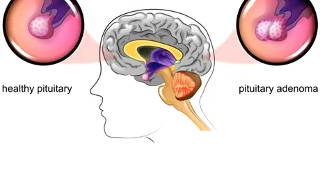 Prolactinom hipofizar: definiţie, simptome, cauze, tratament