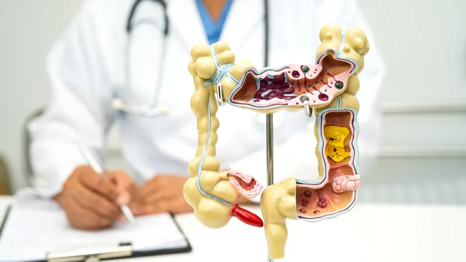 Semnal de alarmă: Creșterea alarmantă a cazurilor de cancer colorectal la tineri