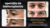 (P) Blefaroplastia superioară: de ce a devenit operația de pleoape cea mai realizată intervenție estetică din lume