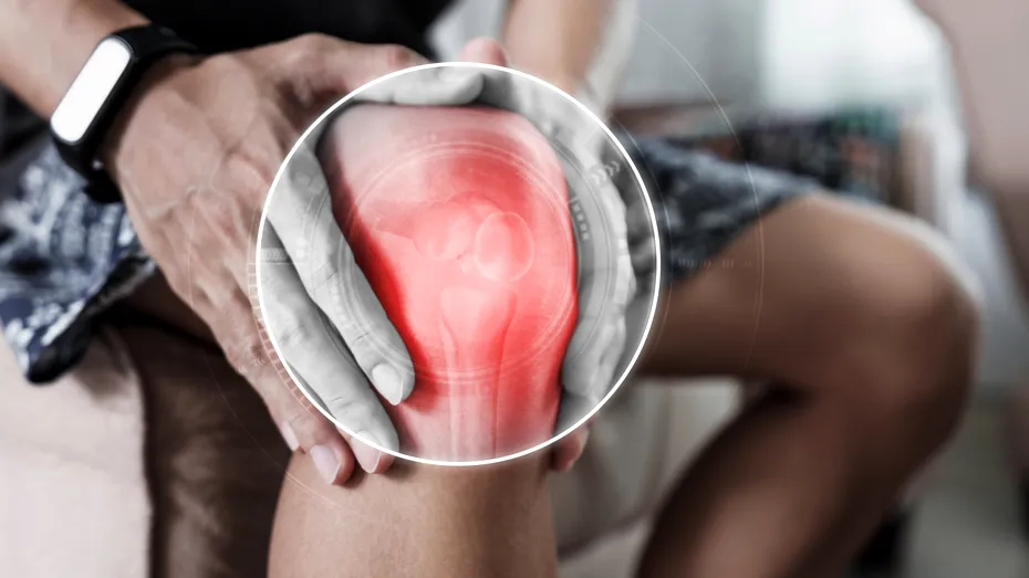 Simți că-ți fuge genunchiul? Ai putea suferi de sindromul de plică sinovială - care sunt cauzele și opțiunile de tratament