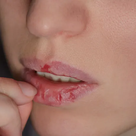 Dermatillomania – când pielea devine ținta unei lupte interioare