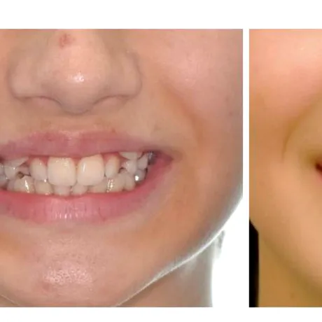 Caninii ectopici (caninii de vampir): ce sunt, cum îi recunoști și care sunt opțiunile de tratament