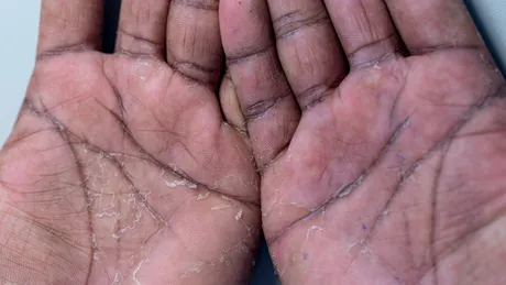 „Ridarea excesivă” de pe mâinile unui tânăr s-a dovedit a fi o afecțiune rară