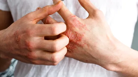 Eczema: cauze, simptome, tratament, prevenţie