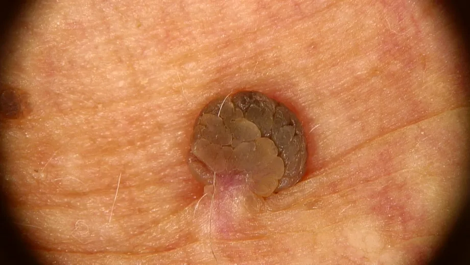 Cum poți scăpa definitiv de papiloame, gratis, cu trimitere. Dr. Michael Russu: „Cea mai simplă metodă este excizia, dar trebuie să prevenim și reapariția”