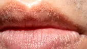 Punctele albe pe buze, penis sau labii nu înseamnă herpes! De ce apar și cum se tratează