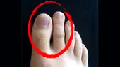 Ai al doilea deget al piciorului mai lung decât degetul mare? Este sau nu o anomalie?