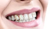 Dinți crăpați, cazuri în continuă creștere. Dentiștii explică fenomenul observat în pandemie