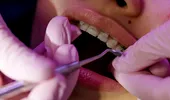 (P) 5 motive pentru care merită să alegi un aparat dentar din safir