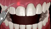 Tratamentul ortodontic al zâmbetului gingival. Ce facem când se vede gingia în timpul râsului?