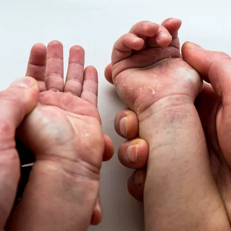 Dermatita atopică la copii – ghid complet pentru părinți