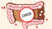 4 boli care cresc riscul de cancer de colon. Ce analize se fac preventiv