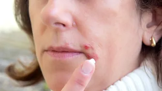 Remedii simple și eficiente împotriva herpesului. Ce funcționează cu adevărat și când trebuie să acționezi