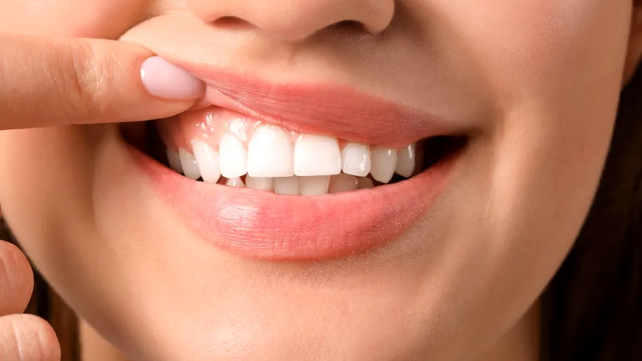 Cum să obții dinți mai albi acasă. Rețeta naturală pentru un zâmbet ca la Hollywood