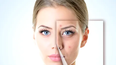 Cele mai mari greşeli pe care le facem când avem acnee