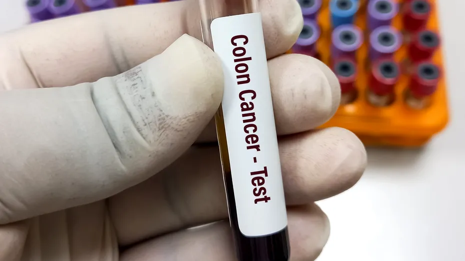 Testul de sânge gratuit care ajută la descoperirea cancerului de colon în stadiu incipient