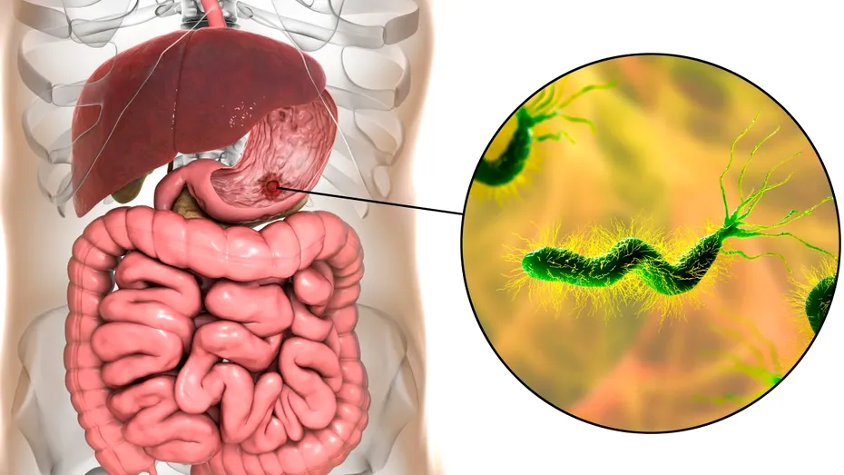 Ce semne dă infecția cu Helicobacter Pylori și care este legătura cu ulcerul și cancerul de stomac