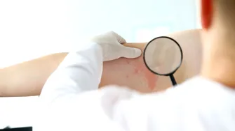 Cazuri de lepră în România! Cum se manifestă şi cum se tratează boala