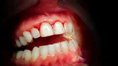 Gingiile sângerează frecvent? Iată ce boli pot fi de vină