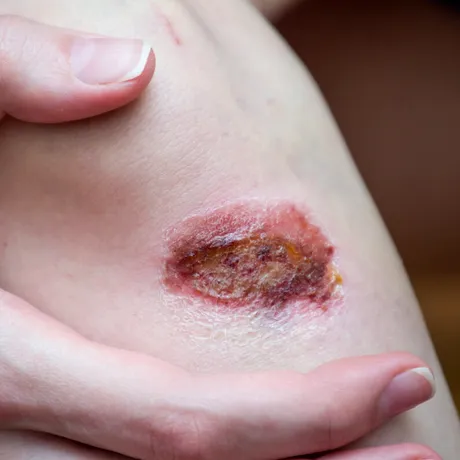 Boli de piele mai periculoase și sinistre decât par. Cum știi dacă ai scabie sau nu