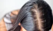 De ce părul se îngrașă mai repede vara. Ce se întâmplă cu scalpul în sezonul cald și cum poți preveni aspectul de păr murdar