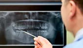 Peste 50% dintre românii cu vârste de peste 40 de ani au lucrări dentare cu plombe cu mercur, tehnică periculoasă, interzisă deja în UE de la începutul anului 2025