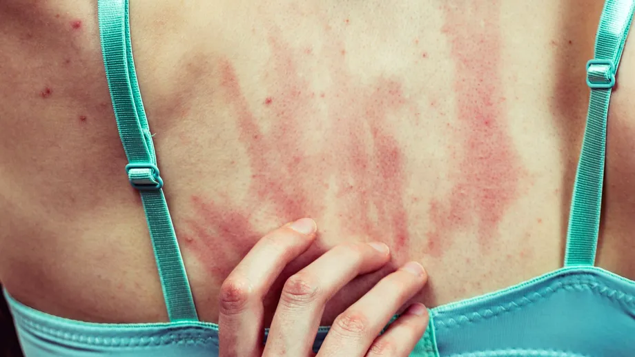 Cum recunoști insecta care te-a înțepat sau mușcat după felul în care arată pielea