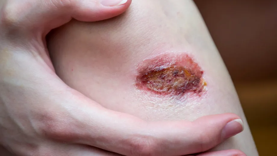 Boli de piele mai periculoase și sinistre decât par. Cum știi dacă ai scabie sau nu