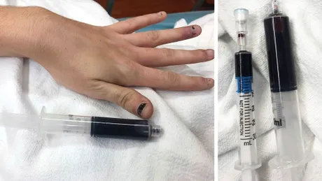 O tânără s-a trezit cu pielea şi unghiile albastre. Medicii au descoperit că i s-a colorat şi sângele. FOTO