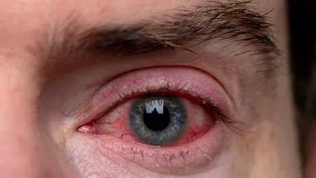 Planul alimentar pentru recuperarea conjunctivitei: alimente recomandate și alimente de evitat pentru vindecare rapidă și protecția ochilor