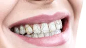 Dinți crăpați, cazuri în continuă creștere. Dentiștii explică fenomenul observat în pandemie