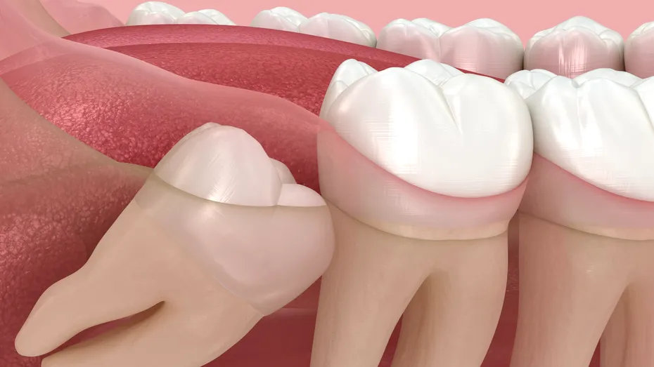 Măselele de minte - ce probleme pot cauza, când trebuie scoase și când să le lăsăm în pace