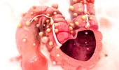 7 semne că ești expus unui risc mare de a dezvolta cancer de colon