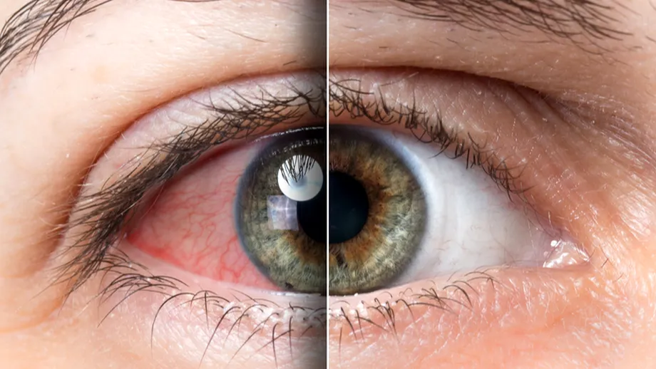 Anomalii oculare produse de COVID-19
