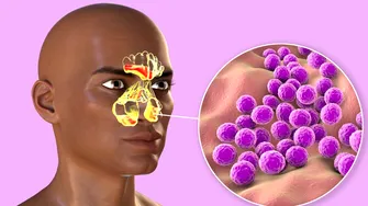 Rinosinuzita, una dintre cele mai frecvente patologii ORL