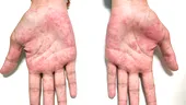 Eczema dishidrotică: ce este, simptome și tratament