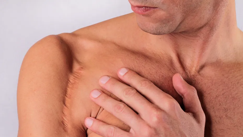 Tratament pentru cicatrici adânci. Beneficii lipofilling sau injectare cu grăsime proprie