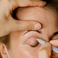 De ce este atât de greu de tratat pielea subțire din jurul ochilor? Majoritatea intervențiilor pot provoca inflamații?