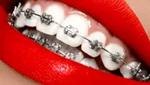 Aparat dentar: semne clare că ai nevoie
