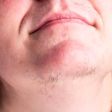 De ce crește părul în barbă la femei. Bolile vinovate pentru părul facial, înainte sau după menopauză