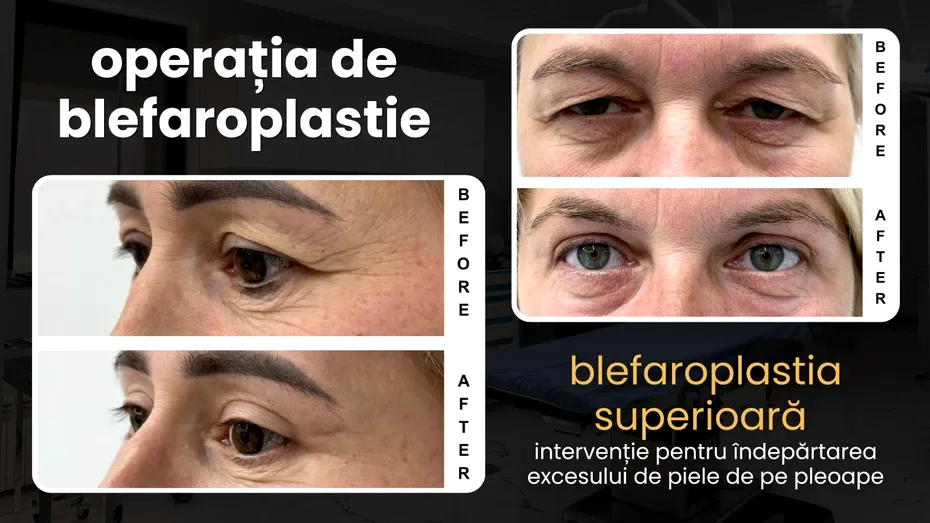 (P) Blefaroplastia superioară: de ce a devenit operația de pleoape cea mai realizată intervenție estetică din lume